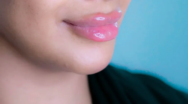 Filler Correction-1 Filler Correction-1