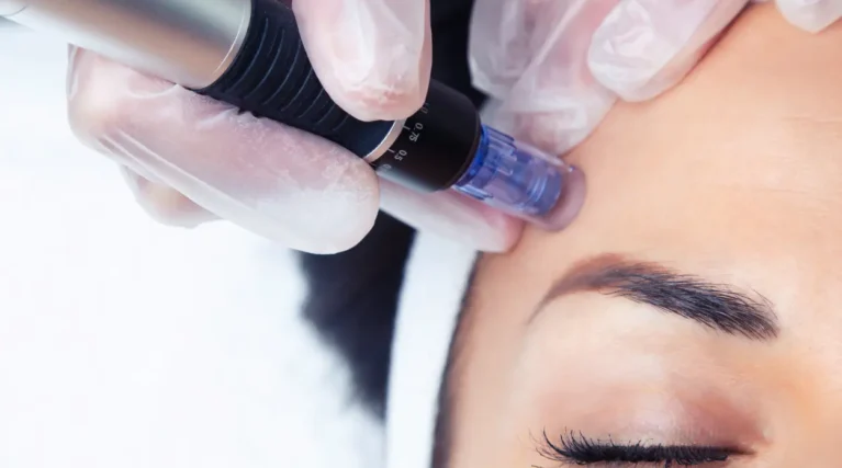 Standard Microneedling-1 Standard Microneedling-1